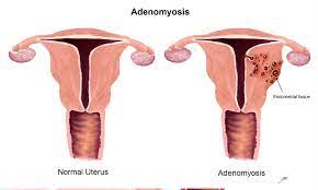 Homeopathy Treatment of Adenomyosis
