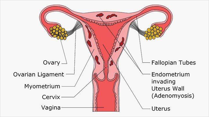 Treatment for Adenomyosis