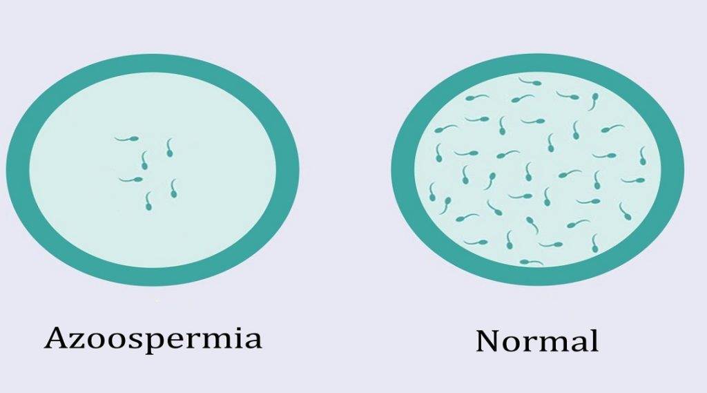 what is Azoospermia