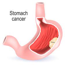 Treatment of Stomach Cancer
