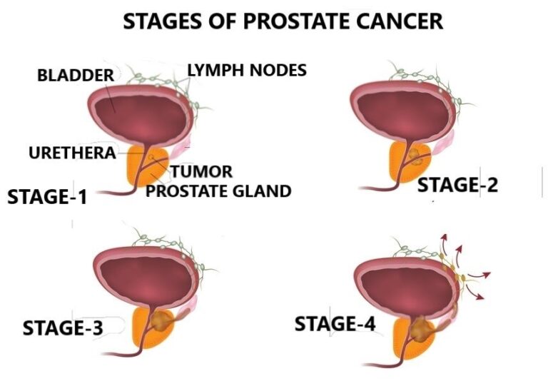 Symptoms of Prostate Cancer? What PSA Levels Should I Have? – Best ...