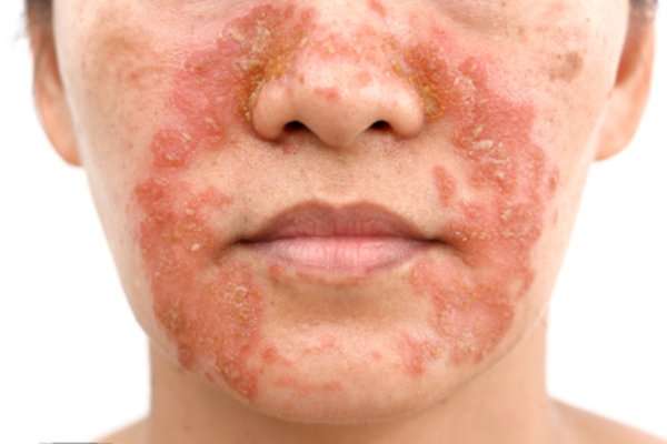 atopic dermatitis on face
