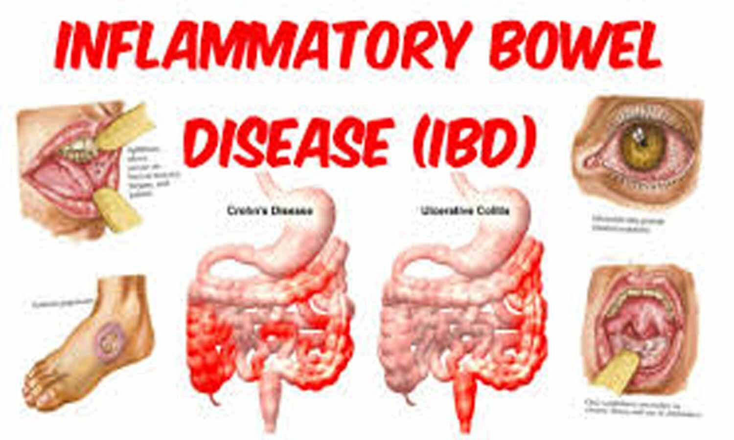 Treatment Of Inflammatory Bowel Disease Ibd Best Homeopathy Doctor In India Us Uk Europe