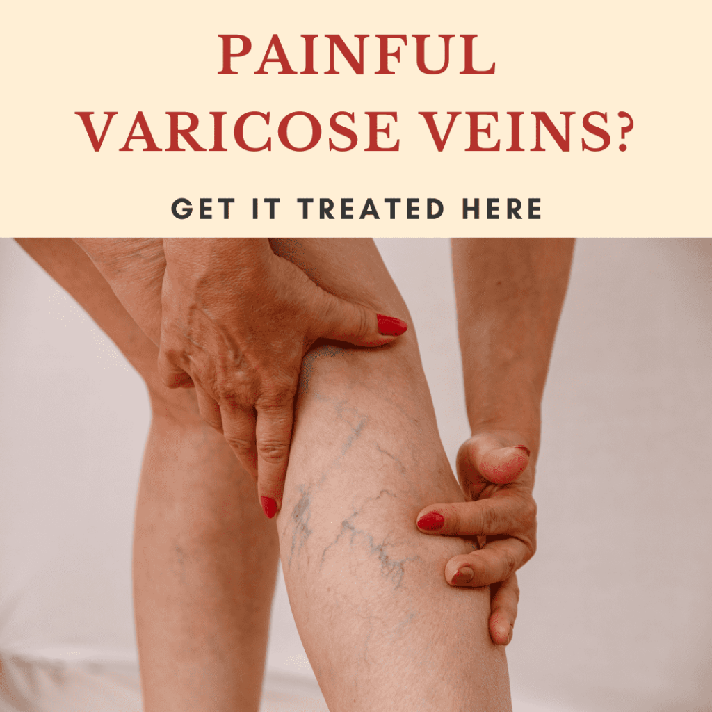 Best Treatments for Varicose Veins: A Complete Guide – Best