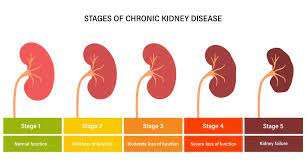 Chronic Kidney Disease