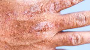 Homeopathy treatment for atopic dermatitis