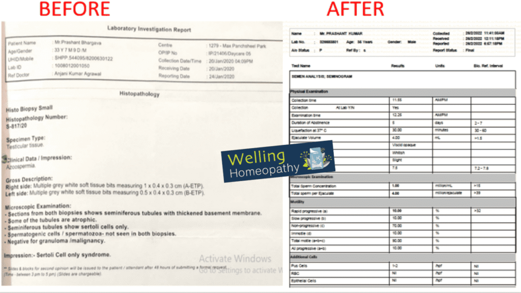 azoospermia treatment review